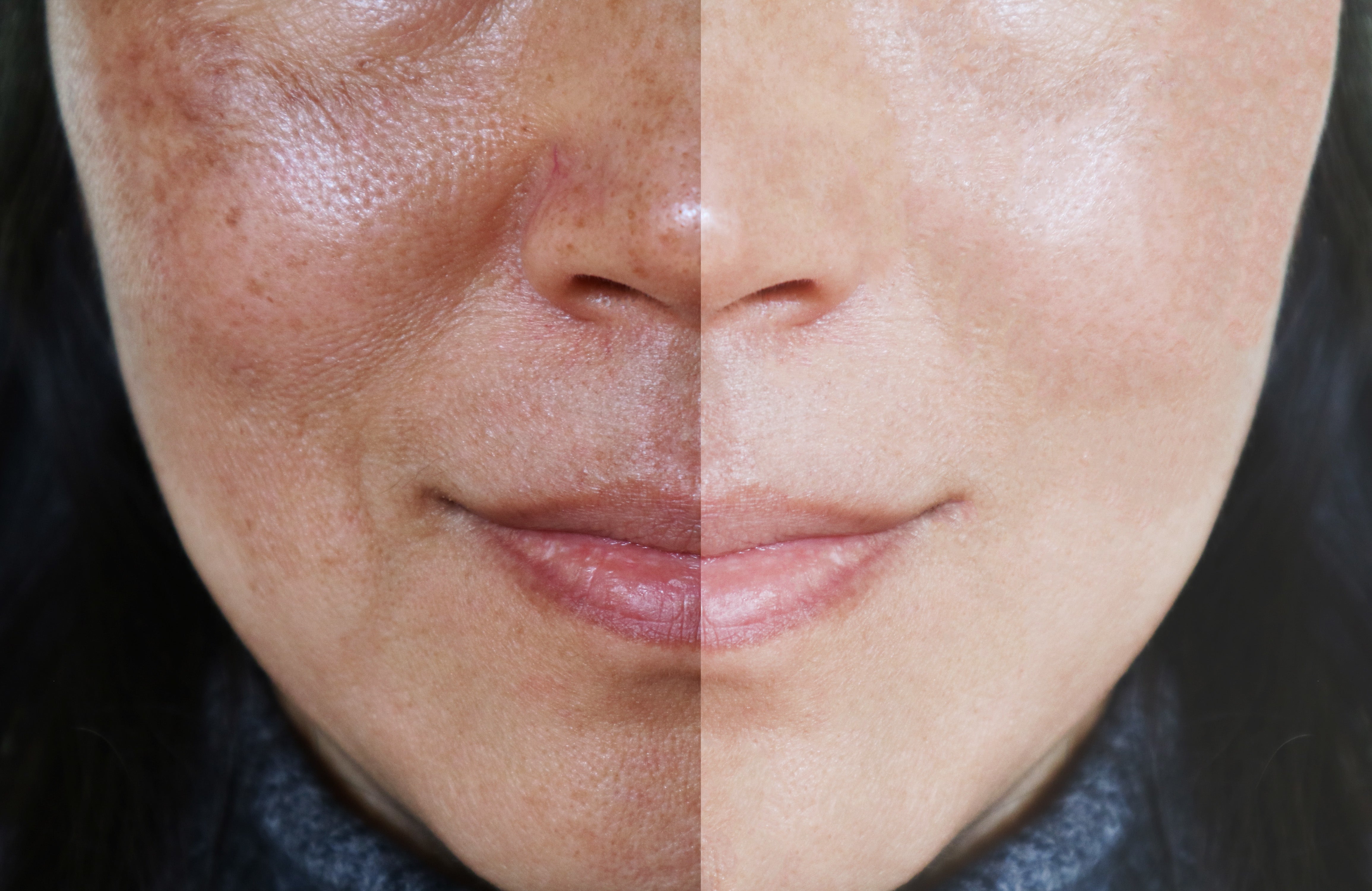What to Do If Your Skin Tone is Uneven  
