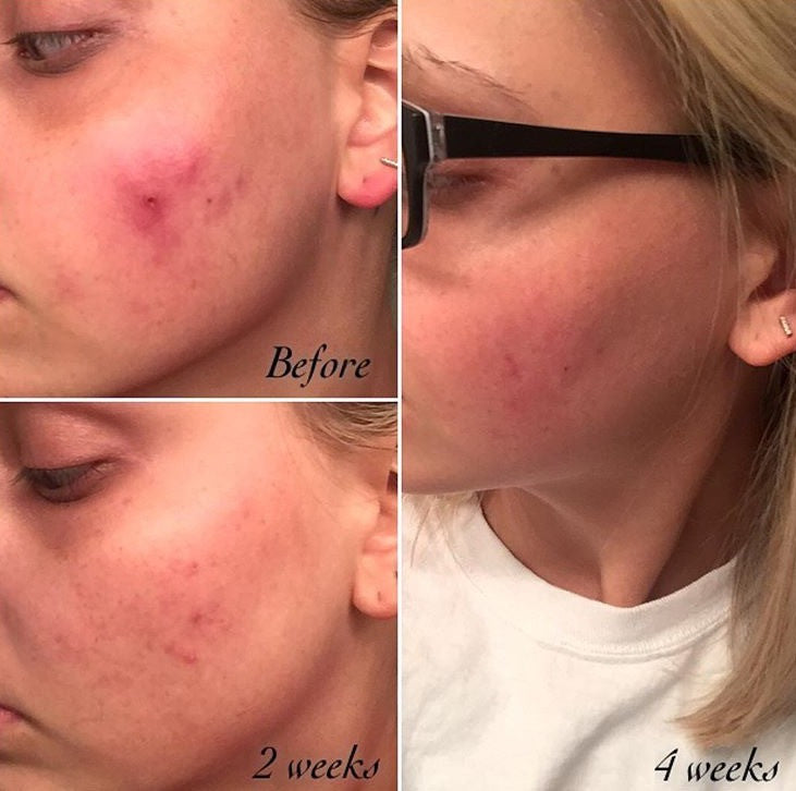 3-Step Acne System