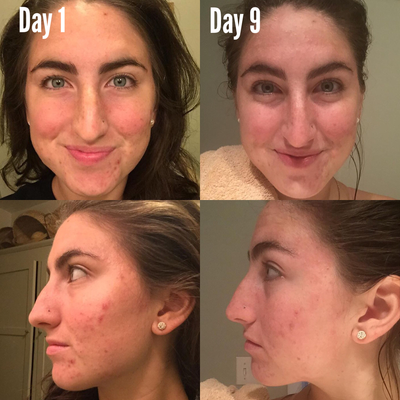 3-Step Acne System