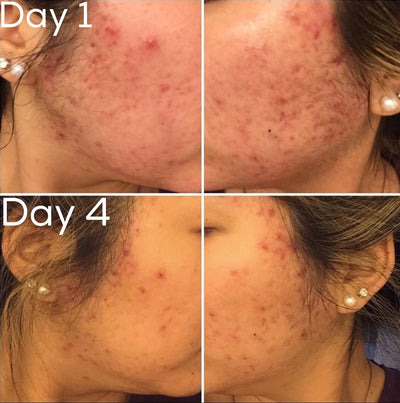 3-Step Acne System