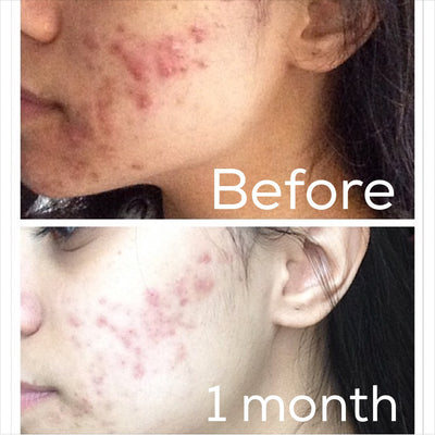 3-Step Acne System